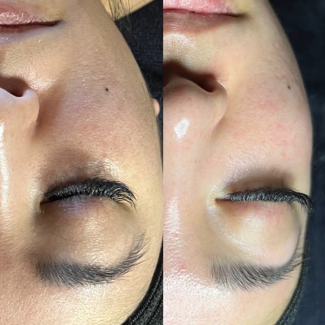 LME Skin Peel Renewal Series at Love Me, Aesthetically Unfiltered in Southlake, TX